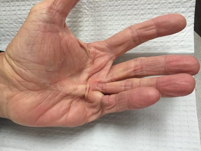 Dupuytrenscontracture-1024×768