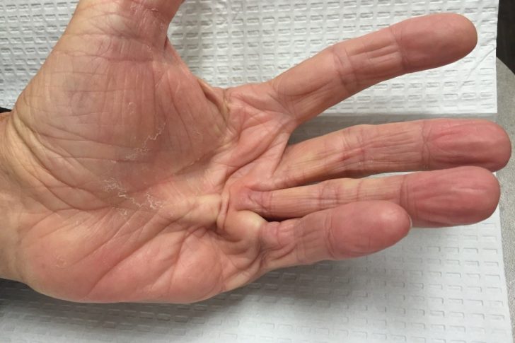 Dupuytrenscontracture-1024×768